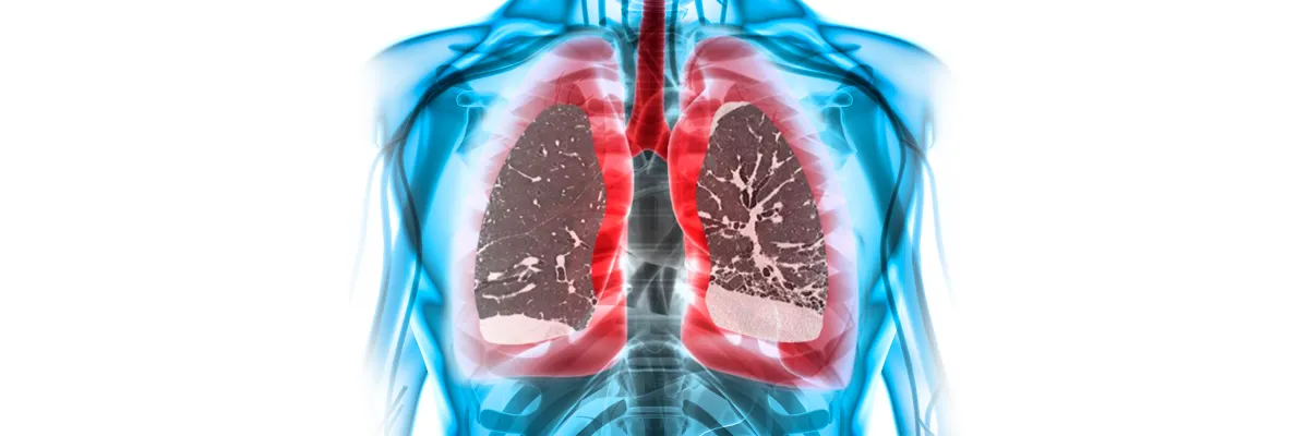 Enfermedad Pulmonar Intersticial
