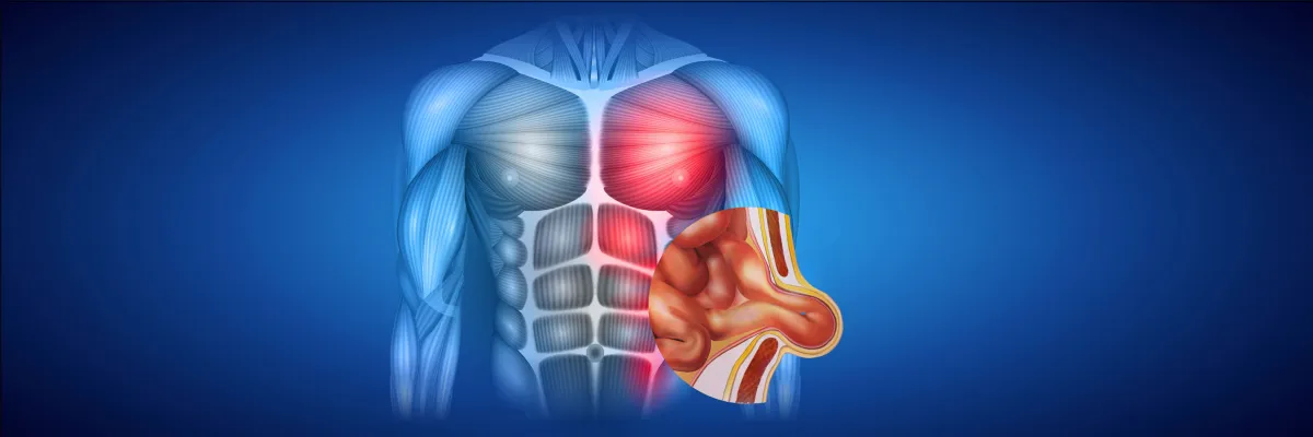 HERNIAS Y PARED ABDOMINAL