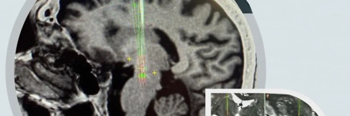 Estimulación Cerebral Profunda Para Parkinson y Otros Trastornos del Movimiento