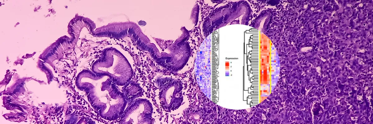 Tumores Neuroendocrinos