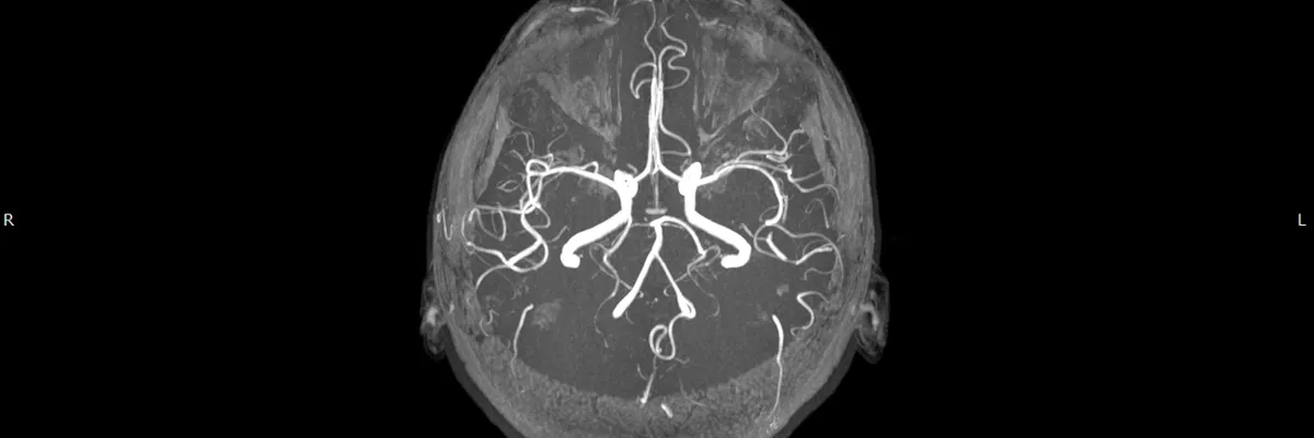 Ataquecerebrovascularfosa