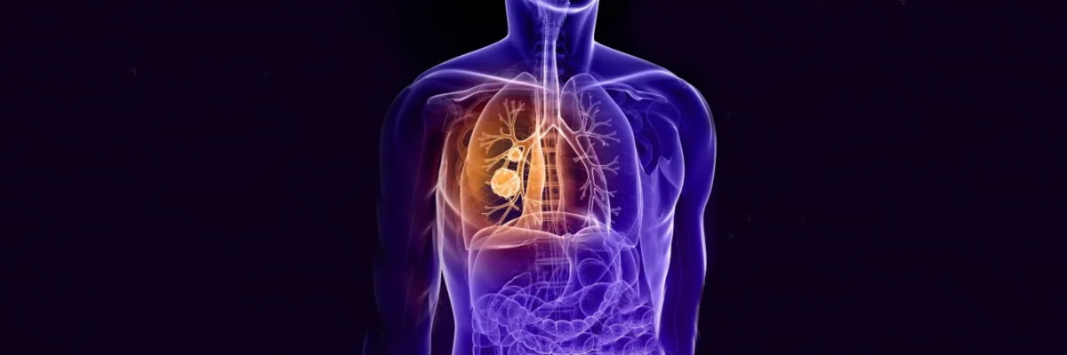 Cáncer Pulmón