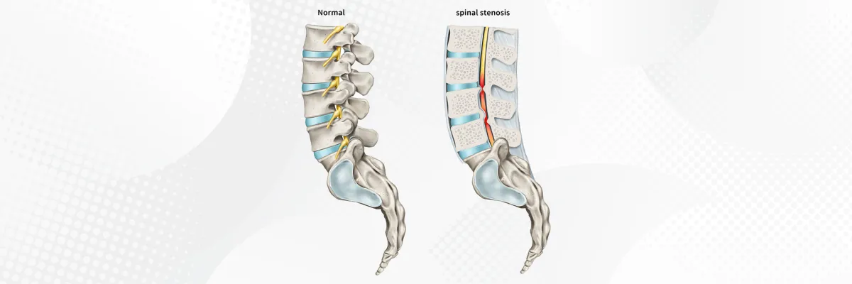 Canal Lumbar Estrecho