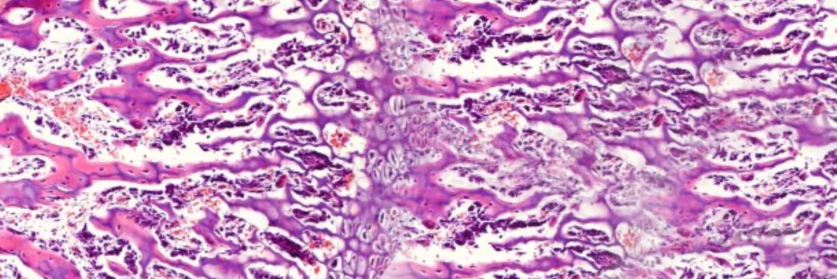Osteoporosis