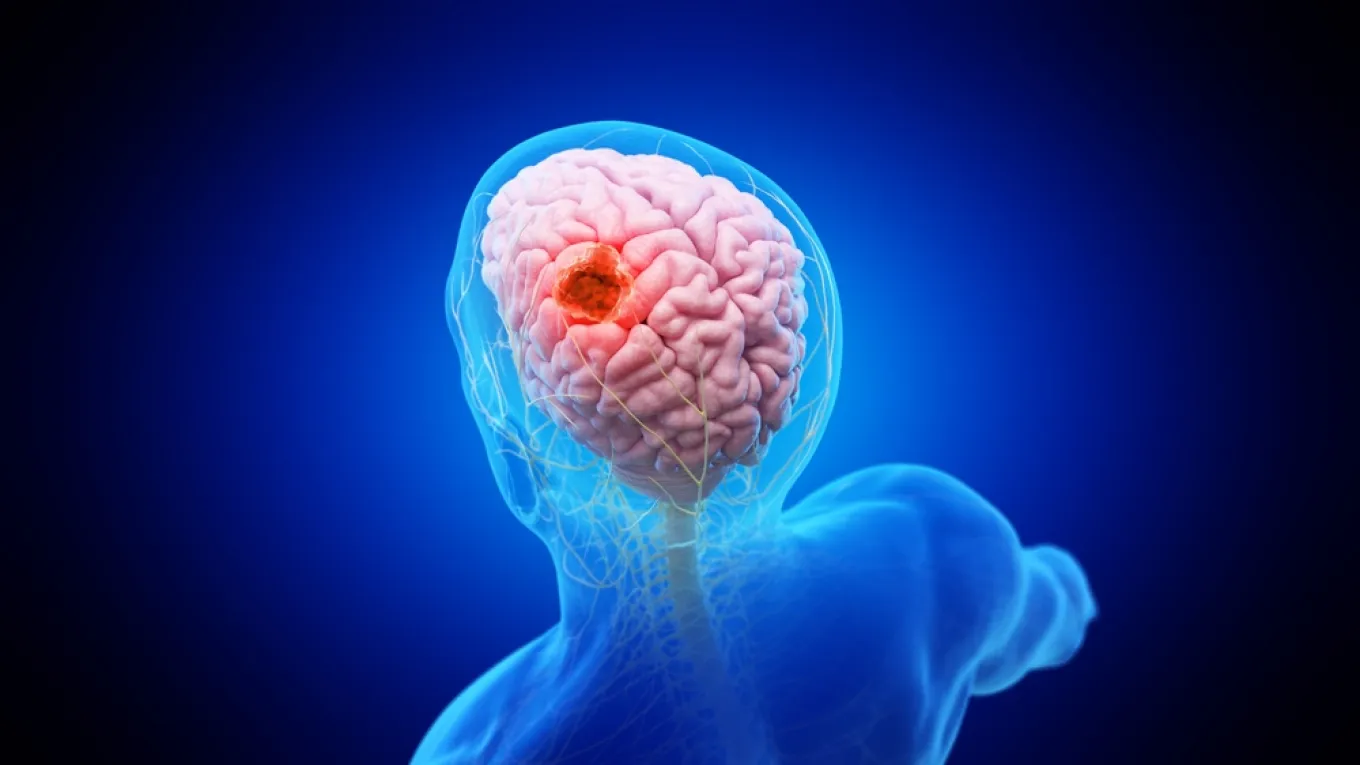 Tumores cerebrales